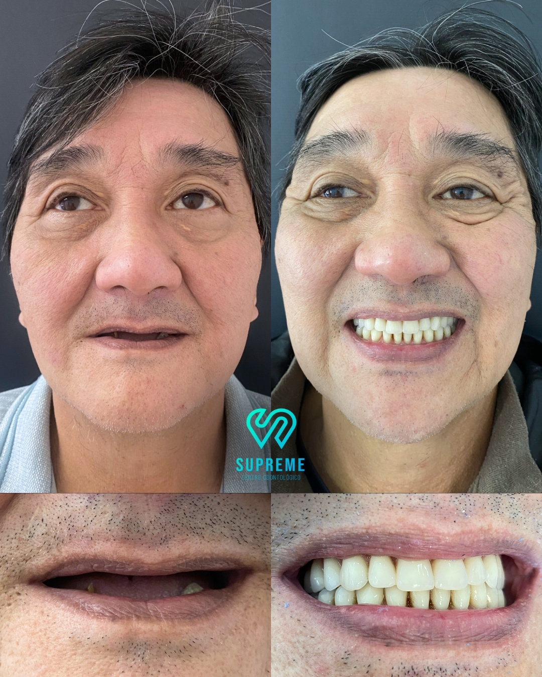 Antes e depois — caso 1